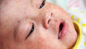菲律宾战役麻疹病例激增