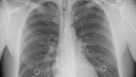 简单的肺部成像方法可以拯救生命